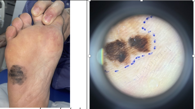 Da chân đổi màu có phải mắc loại ung thư tế bào hắc tố nguy hiểm?- Ảnh 1.