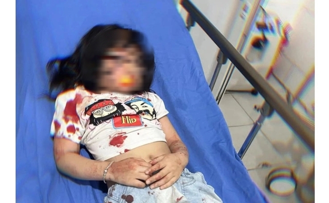 Bé gái 5 tuổi bị chó thả rông cắn trọng thương- Ảnh 1.