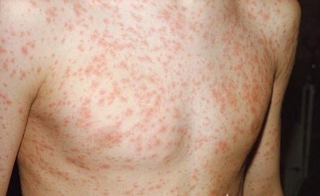 Bệnh sởi, rubella tăng, Bộ Y tế yêu cầu giám sát- Ảnh 1.