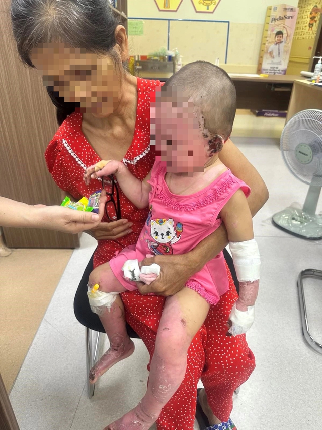 Cứu bé gái 23 tháng tuổi bị bỏng nặng và bé trai sốc sốt xuất huyết - Ảnh 1.