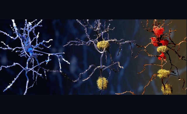 Phát hiện thủ phạm tiềm năng mới của bệnh Alzheimer- Ảnh 1.