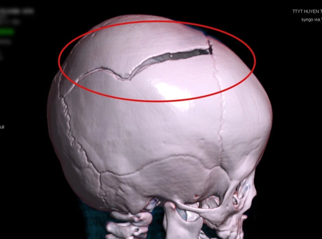 Sập cánh cổng, bé 15 tháng tuổi chấn thương sọ não- Ảnh 1.