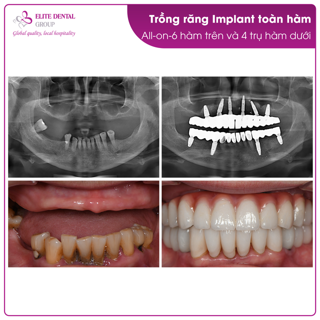 Tận hưởng cuộc sống trọn vẹn tuổi xế chiều nhờ trồng răng Implant toàn hàm- Ảnh 3.
