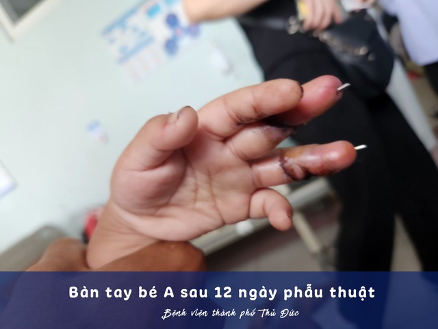 Nỗ lực cứu bàn tay bé trai bị máy quạt chém- Ảnh 2.