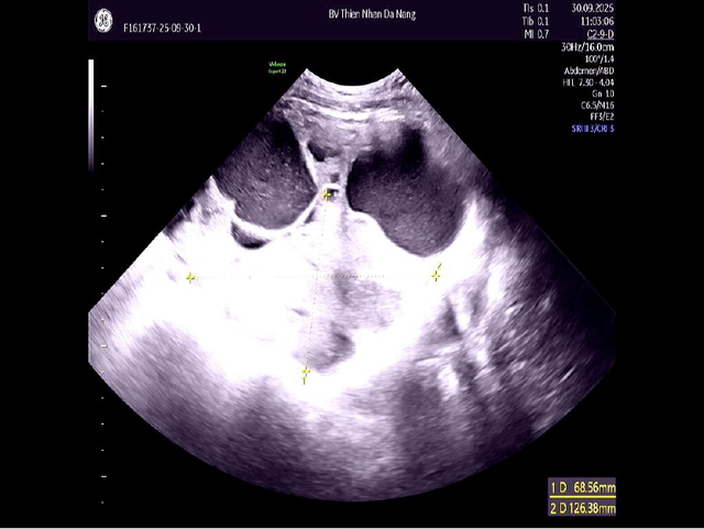 Bằng MRI, Thiện Nhân Hospital phát hiện ung thư buồng trứng ở phụ nữ chưa từng sinh con - Ảnh 2.