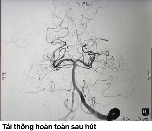 Người đàn ông bất ngờ đột quỵ khi đang uống bia - Ảnh 2.