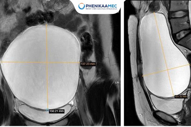 PhenikaaMec phẫu thuật thành công u nang buồng trứng 15cm - Ảnh 1.
