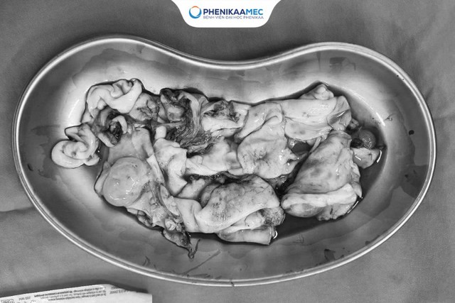 PhenikaaMec phẫu thuật thành công u nang buồng trứng 15cm - Ảnh 2.