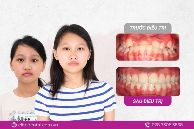 Con móm di truyền từ mẹ: mẹ có thể giúp con "đảo ngược" số phận- Ảnh 3. Con móm di truyền từ mẹ: mẹ có thể giúp con "đảo ngược" số phận- Ảnh 3.