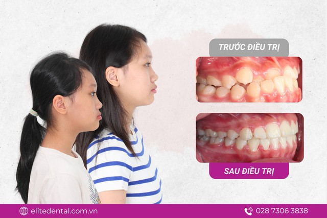 Con móm di truyền từ mẹ: mẹ có thể giúp con "đảo ngược" số phận- Ảnh 4. Con móm di truyền từ mẹ: mẹ có thể giúp con "đảo ngược" số phận- Ảnh 4.