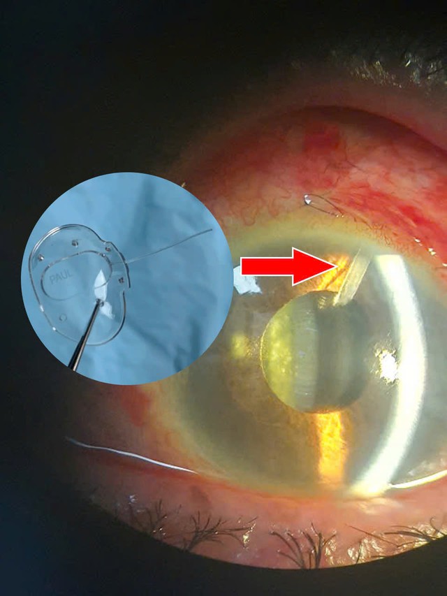 Ca đặt Paul Glaucoma Implant thứ hai, mở ra hy vọng mới cho bệnh nhân glaucoma- Ảnh 2. Ca đặt Paul Glaucoma Implant thứ hai, mở ra hy vọng mới cho bệnh nhân glaucoma- Ảnh 2.