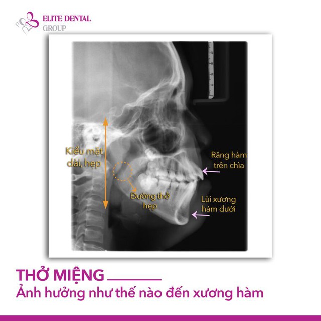 Trẻ thở bằng miệng khi ngủ? Đừng bỏ qua dấu hiệu khiến xương hàm phát triển lệch lạc- Ảnh 4.