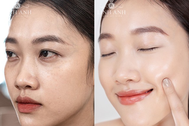 Chọn chuẩn, an tâm trẻ hóa da tại Thẩm mỹ viện Linh Anh- Ảnh 2. Chọn chuẩn, an tâm trẻ hóa da tại Thẩm mỹ viện Linh Anh- Ảnh 2.