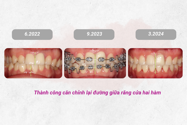 Cân chỉnh đường giữa và chữa lệch mặt bằng phương pháp niềng răng- Ảnh 3.