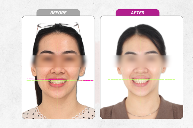Cân chỉnh đường giữa và chữa lệch mặt bằng phương pháp niềng răng- Ảnh 2.