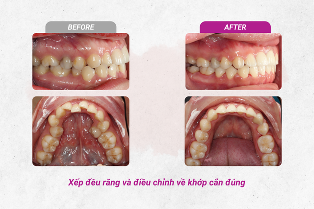 Cân chỉnh đường giữa và chữa lệch mặt bằng phương pháp niềng răng- Ảnh 4.