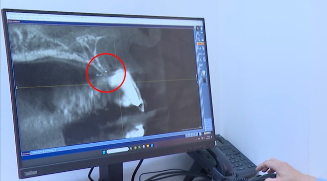 Cấy ghép Implant thành công và vai trò không thể thiếu của ghép xương- Ảnh 2.