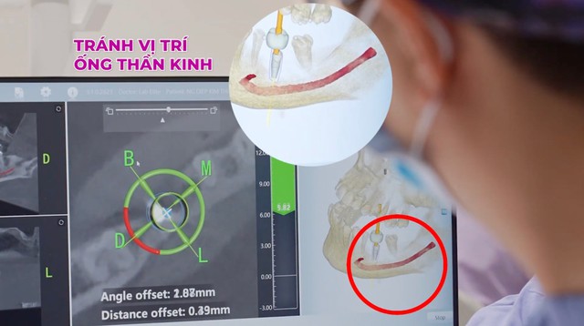 Cấy ghép Implant thành công và vai trò không thể thiếu của ghép xương- Ảnh 3.