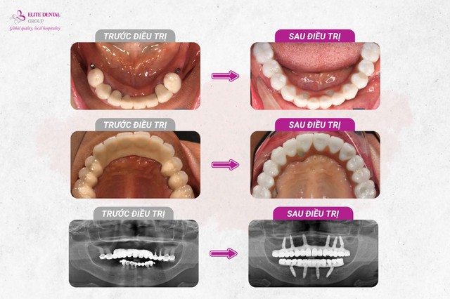 Cấy ghép Implant thành công và vai trò không thể thiếu của ghép xương- Ảnh 4.