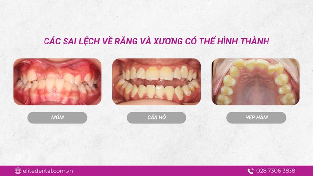 Chỉnh nha sớm cho trẻ: can thiệp đúng lúc – tiết kiệm chi phí- Ảnh 3.