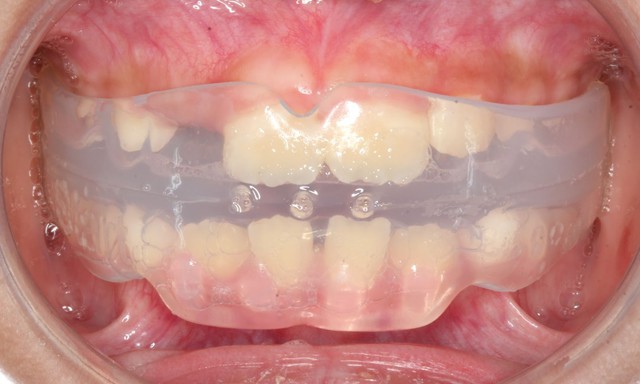 Chỉnh nha sớm cho trẻ: can thiệp đúng lúc – tiết kiệm chi phí- Ảnh 5.