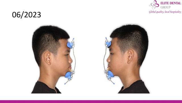 Chỉnh nha sớm cho trẻ: can thiệp đúng lúc – tiết kiệm chi phí- Ảnh 6.