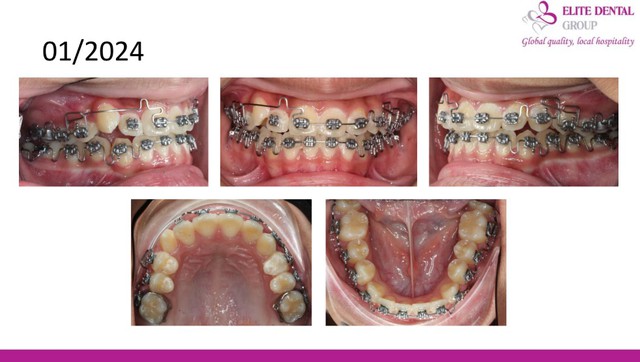 Chỉnh nha sớm cho trẻ: can thiệp đúng lúc – tiết kiệm chi phí- Ảnh 7.
