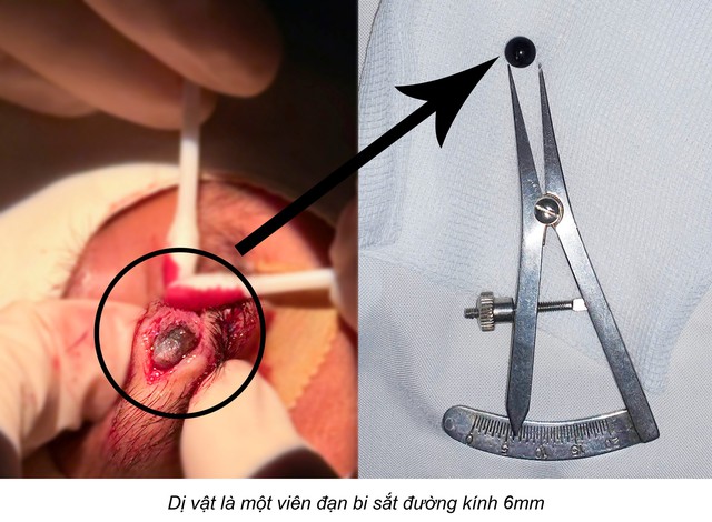 Viên bi sắt 6 mm nằm trong mí mắt nam sinh 15 tuổi suốt nhiều ngày- Ảnh 1.