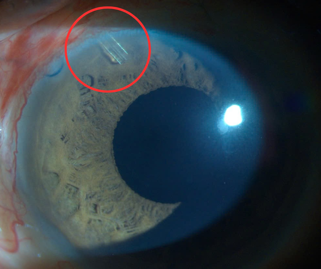 Đặt PGI – Phương phát tân tiến mở ra một cơ hội mới cho bệnh nhân Glaucoma nặng. - Ảnh 4.