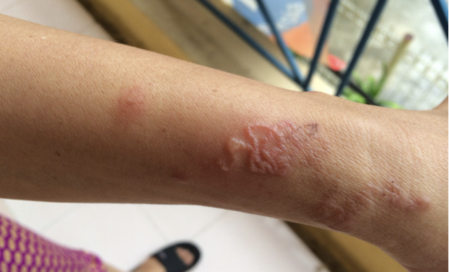 Cùng đau đầu, ba người phát hiện nhiễm ký sinh trùng từ thú cưng - Ảnh 2.