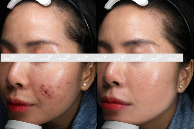 DRH Clinic giải cứu da biến chứng do làm đẹp cấp tốc - Ảnh 1.