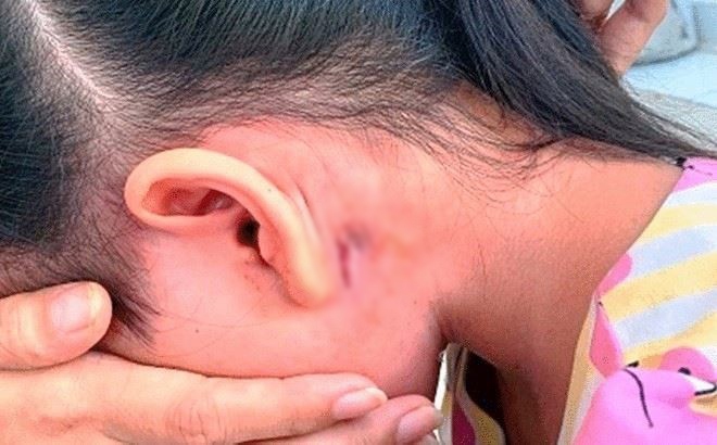 Sự thật kh&oacute; ngờ về vi khuẩn "ăn thịt người"- Ảnh 11.