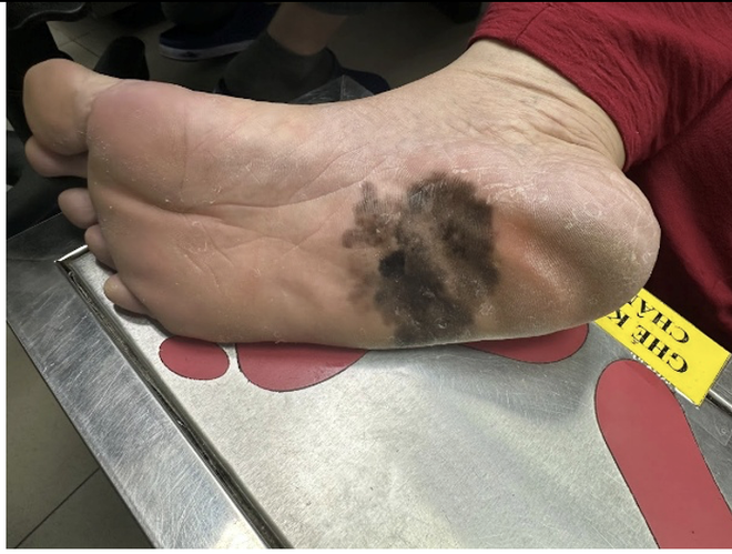 Đốm đen trên da, khi nào là dấu hiệu của ung thư da? - Ảnh 2.