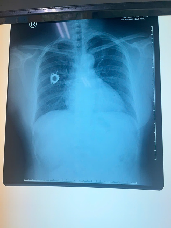 Ống th&ocirc;ng truyền h&oacute;a chất bị bỏ qu&ecirc;n, bị đứt rồi tr&ocirc;i v&agrave;o tim người phụ nữ - Ảnh 2.