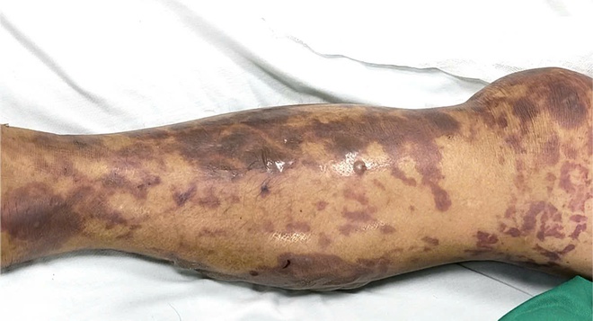 Não mô cầu gây nguy kịch, dễ nhầm với liên cầu khuẩn lợn Nguy kịch do não mô cầu, biểu hiện dễ nhầm liên cầu khuẩn lợn - Ảnh 3.