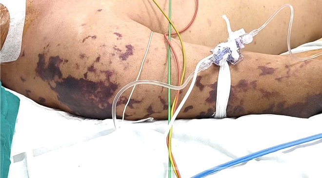 Não mô cầu gây nguy kịch, dễ nhầm với liên cầu khuẩn lợn Nguy kịch do não mô cầu, biểu hiện dễ nhầm liên cầu khuẩn lợn - Ảnh 2.