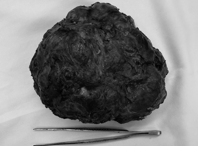 Du học sinh về nước mổ u tuyến v&uacute; 18 cm, bảo tồn to&agrave;n bộ tuyến v&uacute; - Ảnh 3.