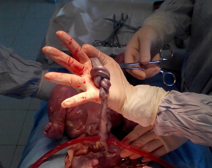 Trong quá trình mổ các bác sĩ phát hiện thai nhi có dây rốn thắt nút 2 vòng to gần bằng nắm tay