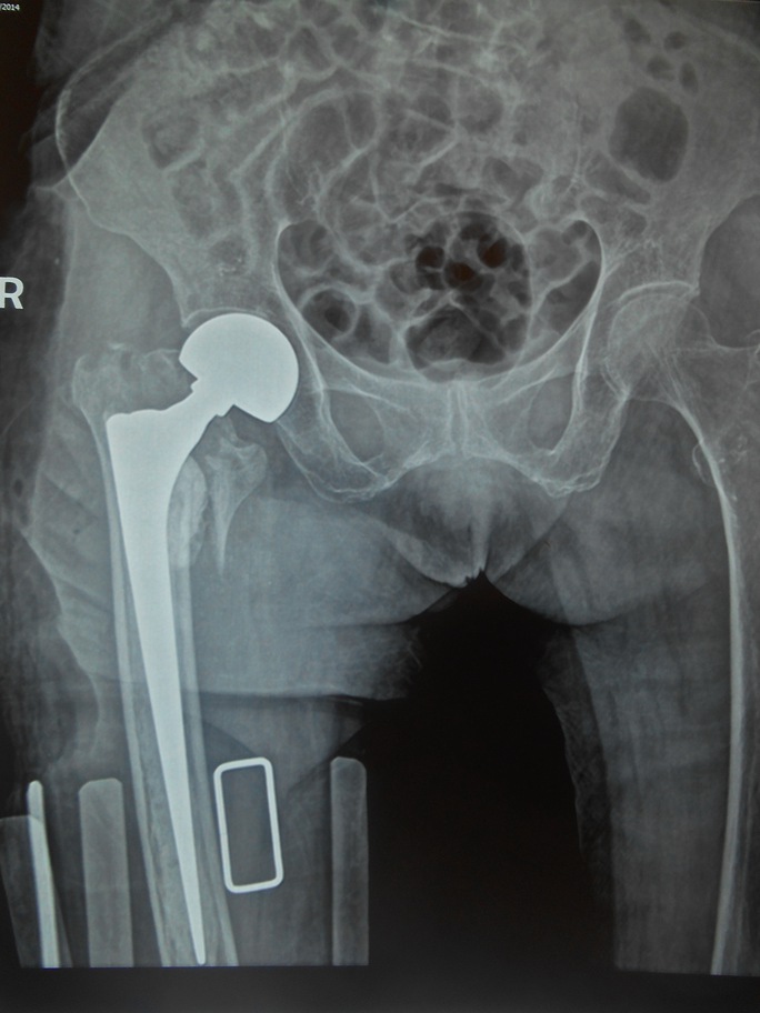 Hình X-quang của cụ Th. sau phẫu thuật thay khớp háng