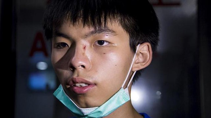 Những vết thương trên mặt Joshua Wong... Ảnh: Reuters