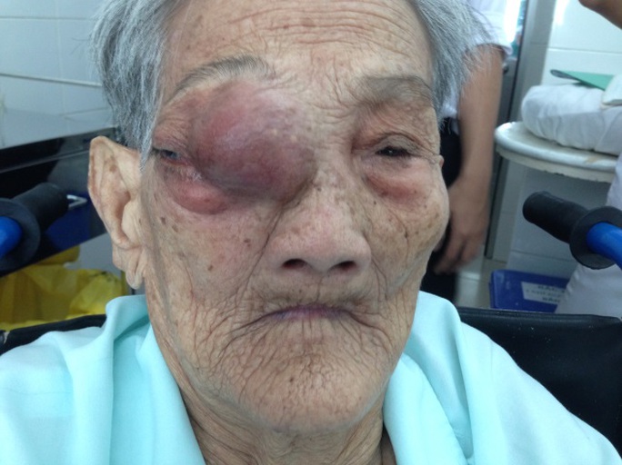 Cụ bà bị khối u đẩy lồi mắt phải ra ngoài.