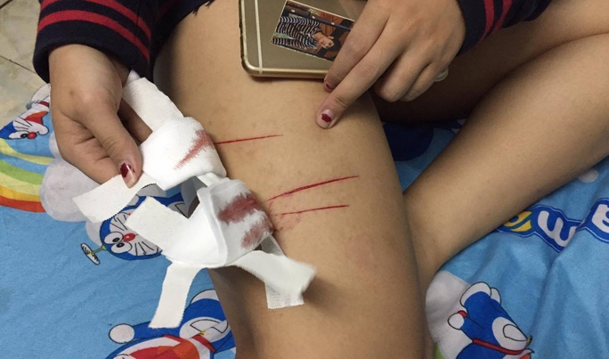 Tối 10-2 một nữ sinh 19 tuổi bị nhóm thanh niên dùng dao lam rạch đùi.