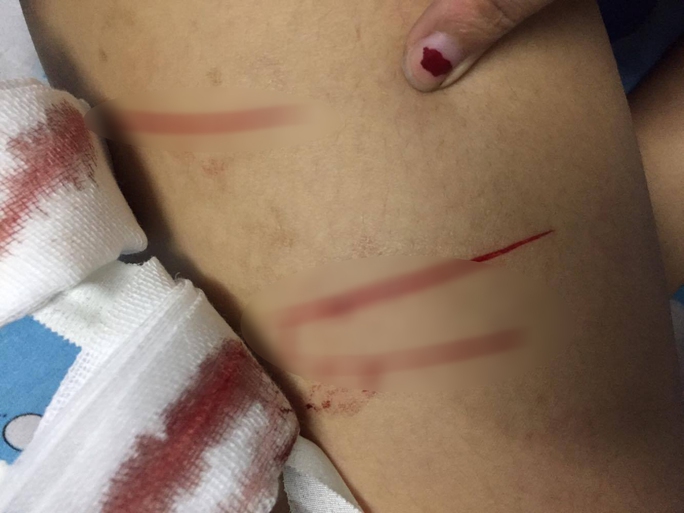 Hiện tại vết thương vẫn khá sâu và nghiêm trọng khiến nữ sinh 19 tuổi trong tình trạng sốt nhẹ và mệt mỏi.