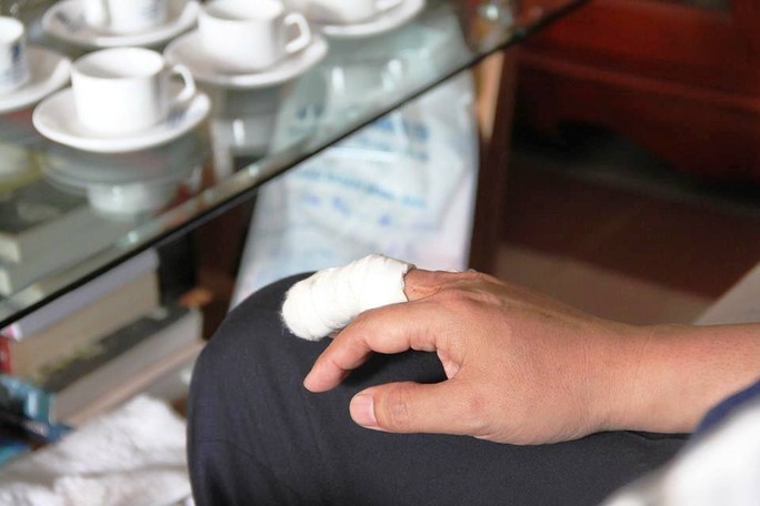 
Ông Nguyễn Văn Đông bị gãy ngón tay và bị thương ở vai trái
