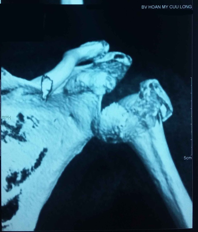 
Hình chụp CT csa81p lớp dựng hình cho thấy phần chỏm xương bị vỡ nát. (Ảnh: PHƯƠNG CHI)
