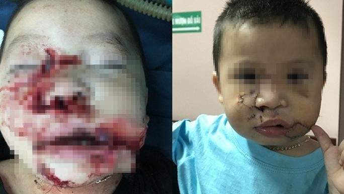 Đang chơi với chó con, bé trai 2 tuổi bị chó mẹ cắn nát mặt - Ảnh 1.
