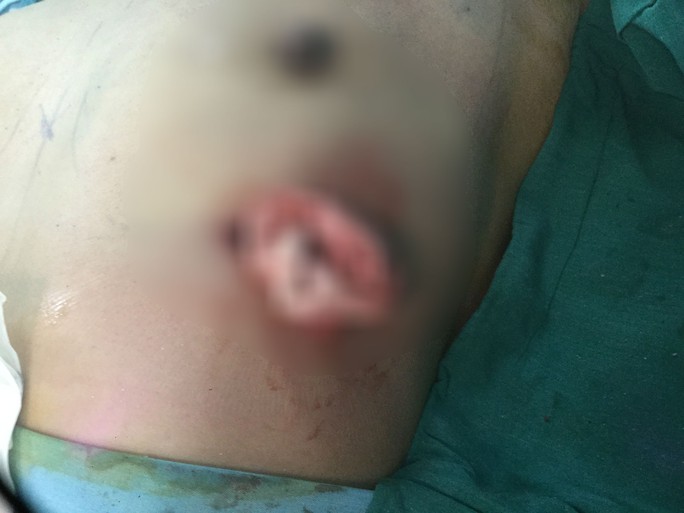 Nâng ngực bị vôi hóa, nữ Việt kiều đau đớn cầu cứu bác sĩ - Ảnh 3.