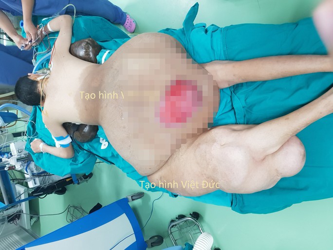 Bác sĩ choáng với khối u khủng nặng 45 kg trên người nam thanh niên - Ảnh 1.
