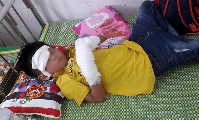 Điện thoại bất ngờ phát nổ, bé trai 7 tuổi dập nát 2 bàn tay - Ảnh 1.