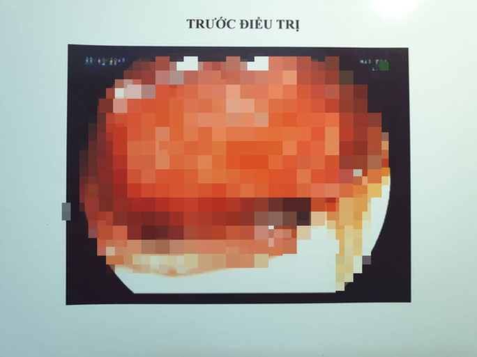 5 phút cứu sống bệnh nhân nôn 1 lít máu đỏ tươi bằng kỹ thuật mới - Ảnh 1. 5 phút cứu sống bệnh nhân nôn 1 lít máu đỏ tươi bằng kỹ thuật mới - Ảnh 1.